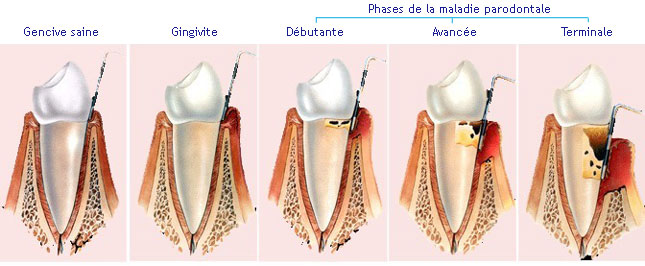 stade-maladie-parodontale